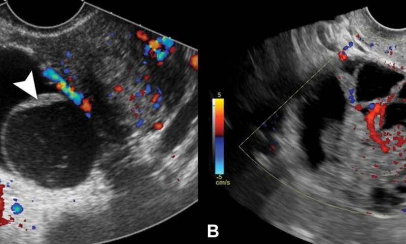 Researchers use ultrasound to predict ovarian cancer