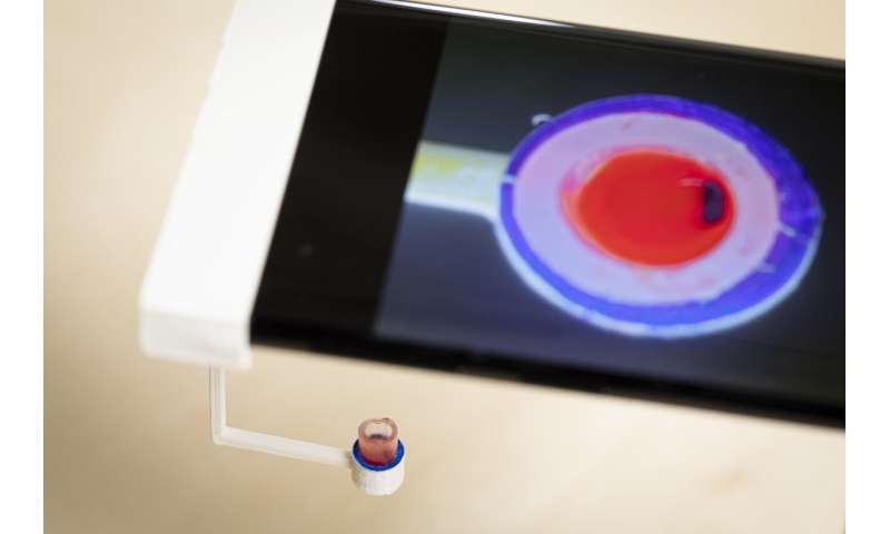 Smartphone app can vibrate a single drop of blood to determine how well it clots