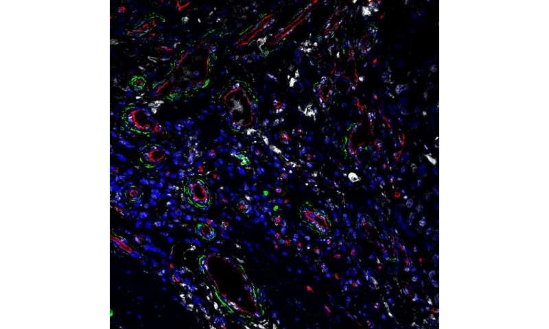 宾夕法尼亚大学的一项研究发现，成纤维细胞中的应激蛋白可能是未来抗癌药物的一个很好的靶点