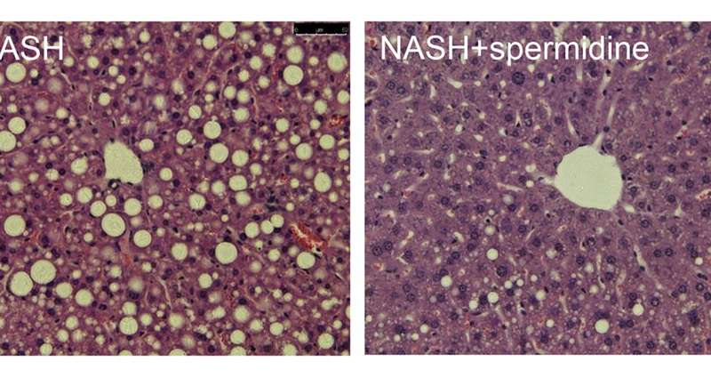Study suggests spermidine could help to treat advanced non-alcoholic fatty liver disease