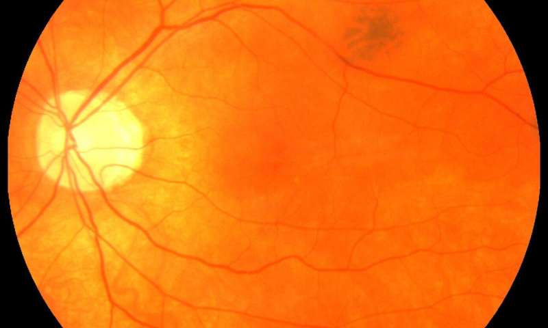 استفاده از چشم به عنوان پنجره ای برای ورود به بیماری قلبی