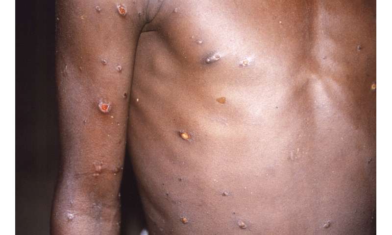 WHO panel: Monkeypox not a global emergency 'at this stage'