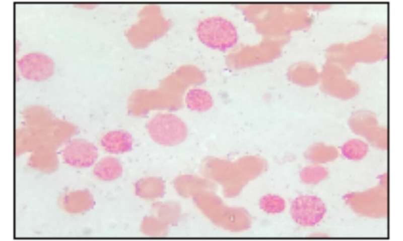A novel chromosomal abnormality in AML patient: Case report and literature review