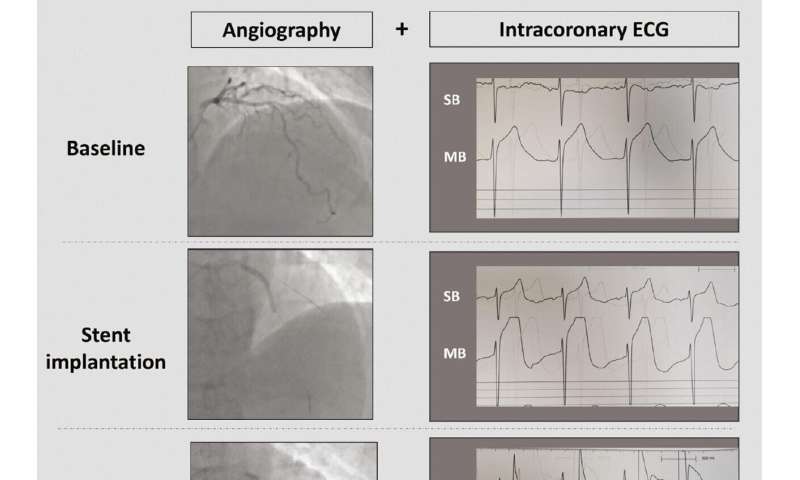 Intracoronary electrocardiography-guided strategy for the treatment of coronary bifurcation lesions