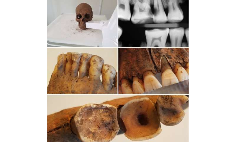 Viking dentistry was surprisingly advanced