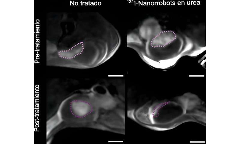 Bladder tumors reduced by 90% using nanorobots