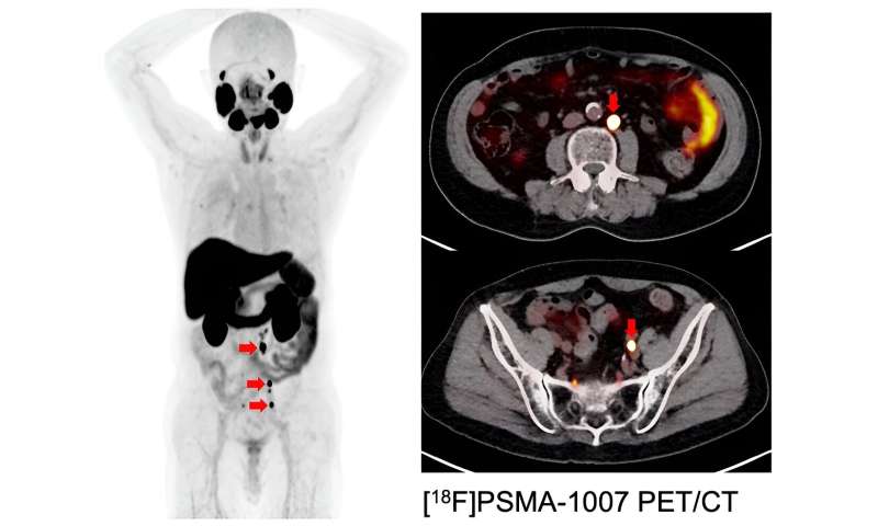 First in-human investigator-initiated clinical trial to launch for refractory prostate cancer patients: Novel alpha therapy targets prostate-specific membrane antigen