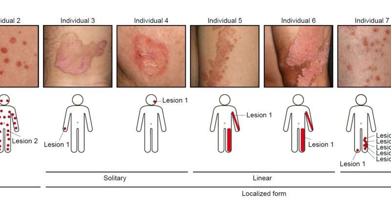 Mosaics of predisposition cause skin disease