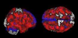 Brain plaques may explain higher risk of Alzheimer's based on mom's history
