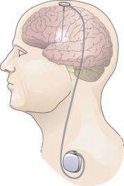 Deep brain stimulation at two different targets gives similar motor benefits in Parkinson's