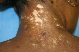 Skin transplant offers new hope to vitiligo patients
