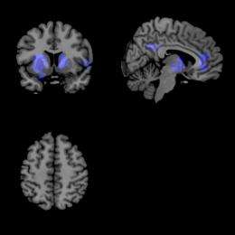 Brain imaging technique: New hope for understanding Parkinson's disease