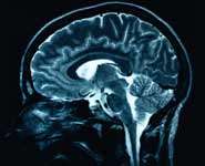 Dementia, high blood pressure and brain blood flow may be linked