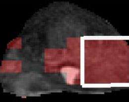 Rutgers researchers assess severity of prostate cancers using magnetic resonance imaging