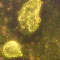 Gold Nanoparticles May Simplify Cancer Detection