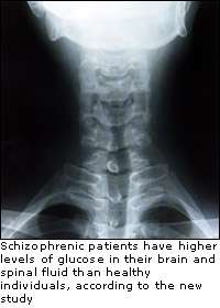 Early warning for schizophrenia found in spinal fluid