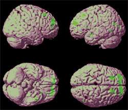 Researchers identify brain network that may help prevent or slow Alzheimer's