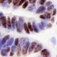 Ovarian Cancer May Mimic Fallopian Tube Formation