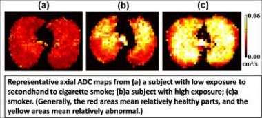 Secondhand smoke damages lungs, MRIs show