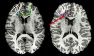 Slow reading in dyslexia tied to disorganized brain tracts