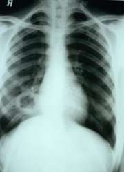 Trials begin for 'essential' new TB vaccine