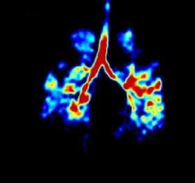 Researchers light up lungs to help diagnose disease