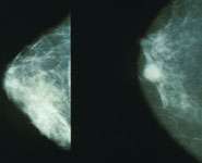 New technology could revolutionize breast cancer screening