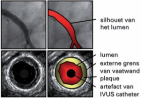 Aggressive lowering of cholesterol has positive impact in atherosclerosis