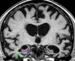 MRI brain scans accurate in early diagnosis of Alzheimer's disease