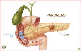 Determining risk for pancreatic cancer