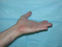 Discovery of New Treatment for Hand Disorder Affecting Millions Shown Promising