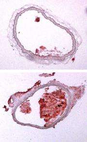 Scientists reveal a new mechanism that increases atherosclerosis in mice