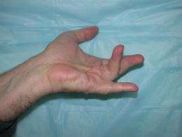Discovery of New Treatment for Hand Disorder Affecting Millions Shown Promising
