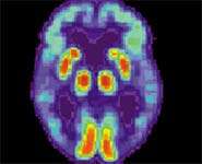 Blood flow in Alzheimer's disease
