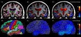 Analyzing structural brain changes in Alzheimer's disease