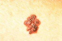 A potential new imaging agent for early diagnosis of most serious skin cancer