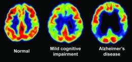 Memory test and PET scans detect early signs of Alzheimer's