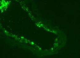 MicroRNAs hold promise for treating diseases in blood vessels