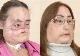 Nation's first face transplant patient shows face (AP)