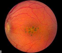 New inherited eye disease discovered