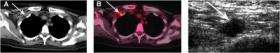 PET/CT Scan Shows Inflammatory Breast Cancer