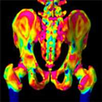 New imaging technology predicts fracture risk