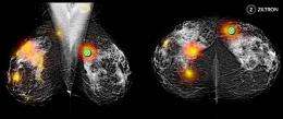 Improving early detection of breast cancer