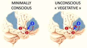 New test may help distinguish between vegetative and minimally conscious state
