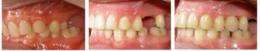 Tooth movement an alternative to bone transplants