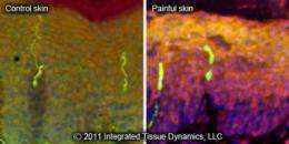 Researchers discover potential cause of chronic painful skin