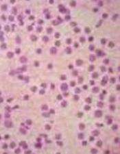 Scientists look to immune system to handle follicular lymphoma