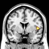 Brain scans reveal differences in brain structure in teenagers with severe antisocial behavior