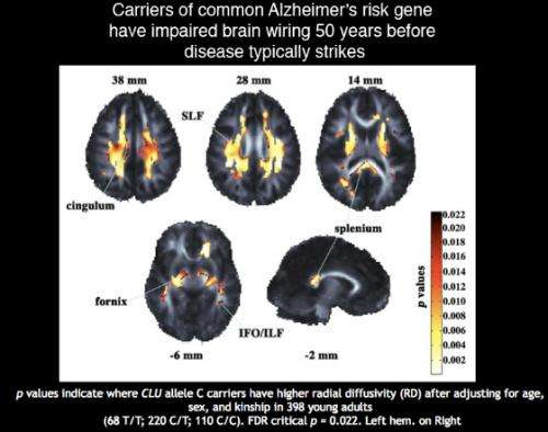 Alzheimer's risk gene disrupts brain's wiring 50 years before disease hits