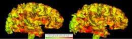 Brain enlargement in autism due to brain changes occurring before age 2